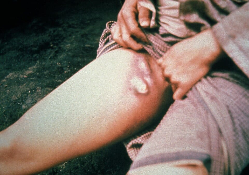 A bubo on the upper thigh of a person infected with bubonic plague